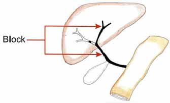 Pediatric liver transplantation hospital in Chennai, Pediatric liver transplantation hospital in India, pediatric liver and gi specialist in chennai, pediatric liver and gi specialist in India, Pediatric Liver specialist in India